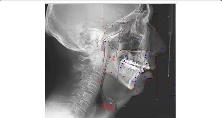 Fig. 2 Lateral cephalograph of a sample patient before maxillo-mandibular advancement surgery