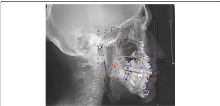 Fig. 4 Lateral cephalograph of a sample patient after maxillo-mandibular advancement surgery