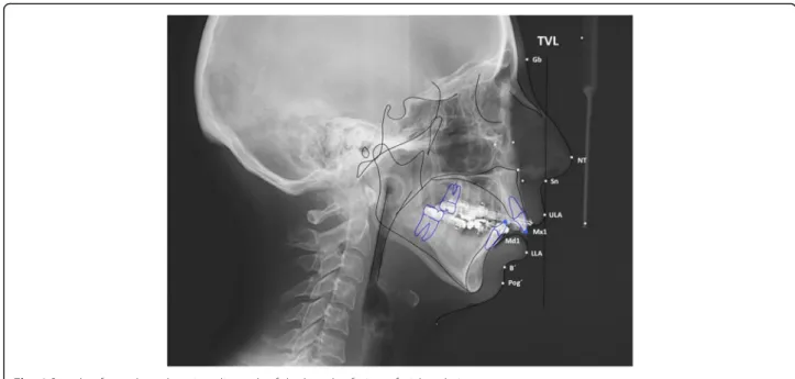 Fig. 6 Sample of a cephamolmetric radiograph of the lateral soft tissue facial analysis