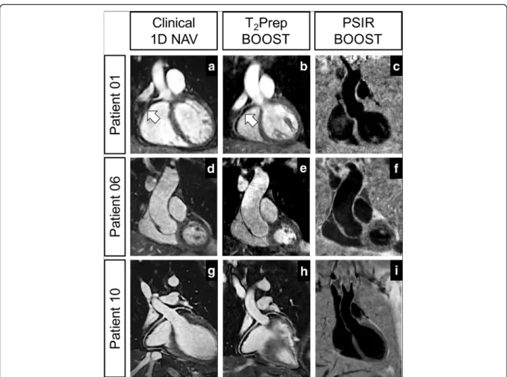 Fig. 6 Comparison between conventional 3D whole-heart acquisition with diaphragmatic navigator and the proposed bright-blood T 2 Prep BOOST