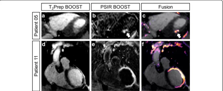 Fig. 7 Fusion of the bright-blood T 2 Prep BOOST and the black blood PSIR BOOST datasets