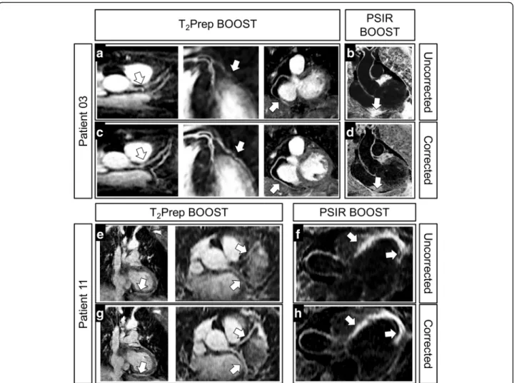 Fig. 4 Improvement in BOOST image quality after translational motion correction in two representative patients