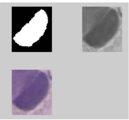 Figura 7. Imagen contenida en una celda del cell array para una célula del tipo Anormal Carcinoma 