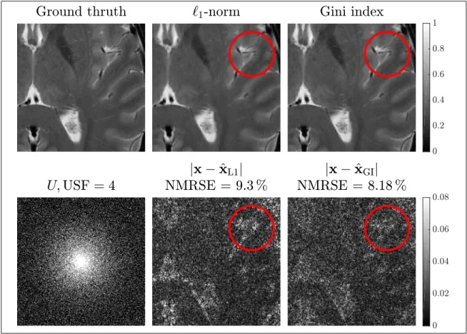Figure I.4.3. Results for MRI data of a brain at an USF of 4. The errors in the obtained reconstructions is less for the GI measure of sparsity and the characteristics of the errors agree with the results obtained in the phantom, being less and most notice