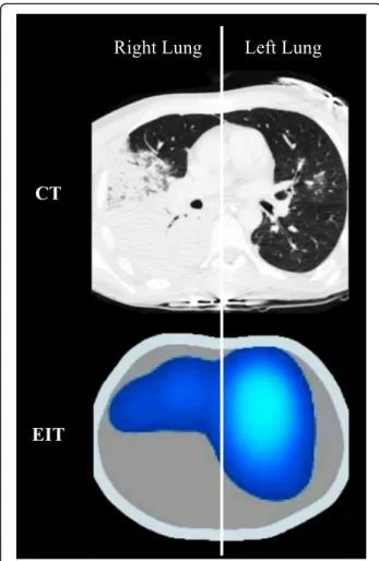 Fig. 4 Computed tomography (CT) of a patient with pneumonia and corresponding functional image obtained from electrical impedance tomography (EIT)