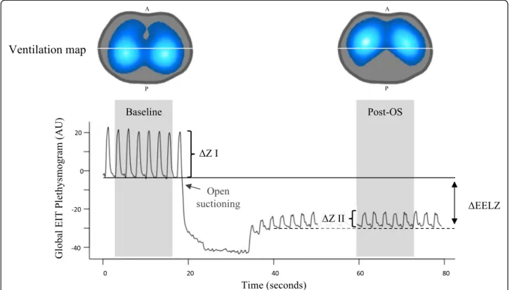 Fig. 8 Global electrical impedance tomography (EIT) plethysmogram and ventilation map during open suction (OS) in model of severe ARDS.