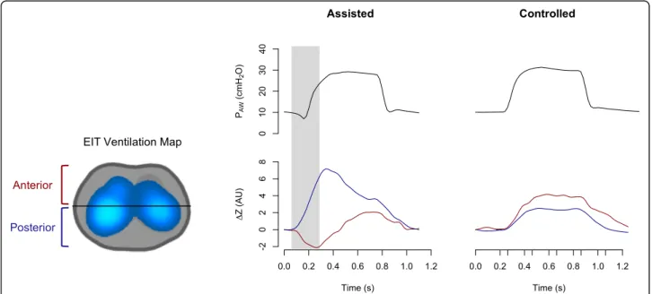 Fig. 10 Pendelluft phenomenon. Variation of impedance ( ΔZ) and airway pressure in assisted and controlled mechanical ventilation (P AW )