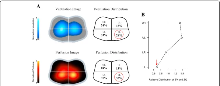 Electrical impedance tomography in acute respiratory distress syndrome