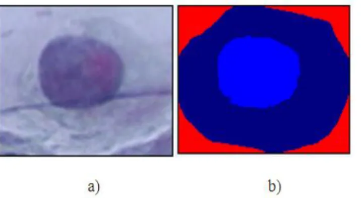 Figura  9.  a)  Célula  perteneciente  a  la  clase  6  (anómala)  en  formato  (RGB),  b)  imagen  segmentada, donde pueden observarse el núcleo (azul claro) y el citoplasma (azul oscuro)