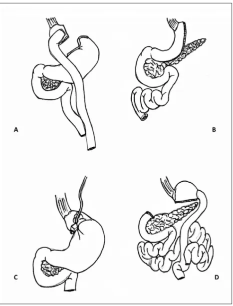 figura 1. Procedimientos	  quirúrgicos	utilizados	en	el	tra-tamiento	de	la	DM2.	A: Bypass  gástrico;	 B:  Gastrectomía	 en	 manga;	 C:  Banda	 inflable;	