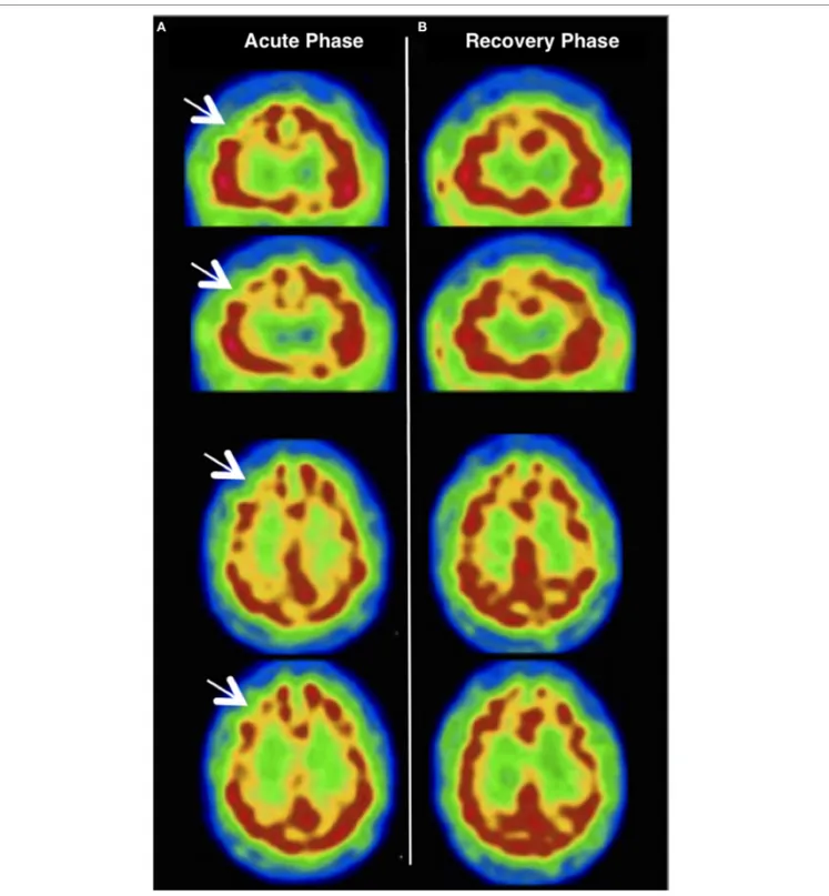 FIGURe 2 | (a) Brain 99mTc-hexamethylpropyleneamine oxime single-photon emission computerized tomography (99mTc-HMPAO SPECT) performed 13 days  after the onset of symptoms revealing a significant decrease in regional cerebral blood flow (rCBF) within the r