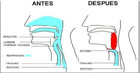 Figura 1.3. Laringectomía total 