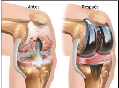 Figura 2.2: Colocación de la prótesis de rodilla. 