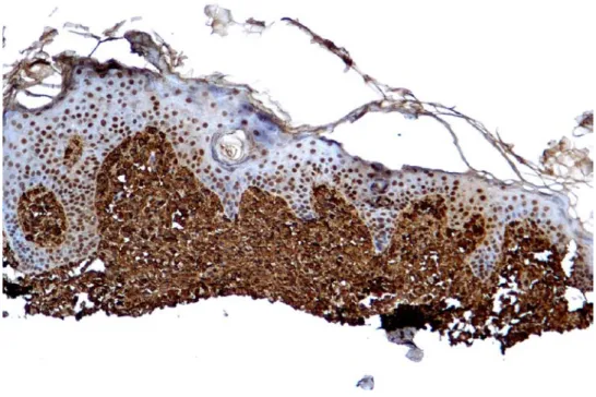 Figura  4: biopsia cutánea (IHQ triptasa) de un paciente pediátrico con mastocitosis  cutánea difusa