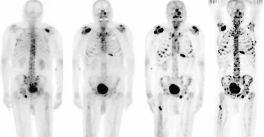 Figura  5.  Paciente  con  cáncer  de  próstata  que  presenta  múltiples  metástasis  óseas  (puntos  negros