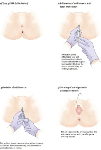 Figura 4 Propuesta de manejo quirúrgico de la infibulación 