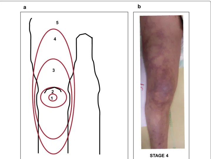 Fig. 4  a The mottling score, ranging from 0 to 5, is based on skin mottling area extension on legs
