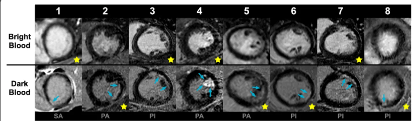 Fig. 4 Short-axis bright-blood and dark-blood LGE image of all eight discordant cases