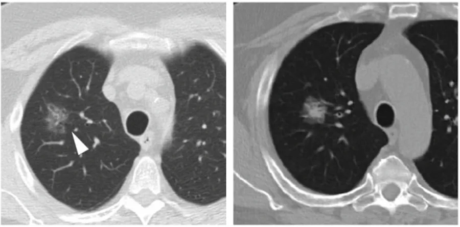 Figura 2.16: izq: CT axial muestra n´ odulo GGO con irregularidadesy lucencias, caracter´ısticas asociadas con tumor m´ınimamente invasivo