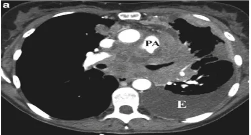 Figura 2.21: SCLC con met´ astasis pleural y pericardial. La imagen CT muestra la masa invadiendo el mediastino, estrechando la arteria pulmonar (PA) izquierda y efusi´ on pleural (E).