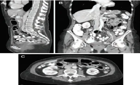 Figura 2.24: Im´ agenes de CT de abdomen y pelvis en vistas sagital (A), coronal (B) y axial(C).