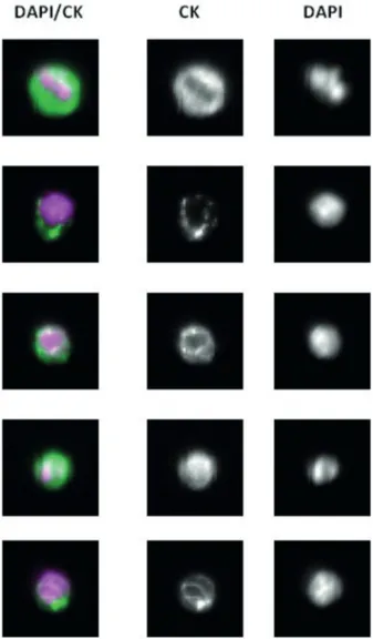 Figura A.- Distintos ejemplos de CTCs en CPNCP marcadas con CK y DAPI, identificadas  mediante el método CellSearch System® (Janssen Diagnostics, LLC, 2016)