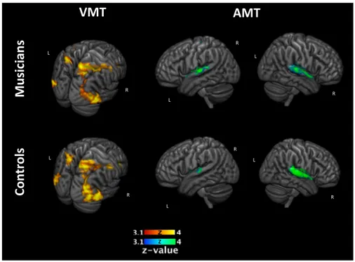 Figure 8: Whole brain activation for musicians and controls during memory tasks after auditory  selective attention encoding phase in musically trained and control children (corrected p &lt; 0.05)