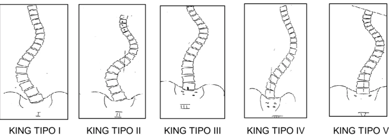 Figura  1.5.  Clasificación  King  &amp;  Moe  de  la  Escoliosis  Idiopática:  King  tipo  I:  Curva  primaria  lumbar  mayor  que  la  curva  torácica  compensadora