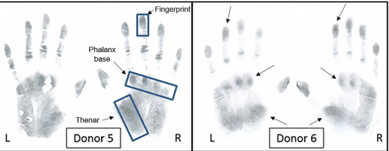 Figure  1.  Scanned  images  of  handprints  from  donor  5  and  6  (L,  left  and  R,  right)  after  the  donors  had  handled  black  powder