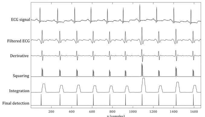 Figure 3.5-2. Pan &amp; Tompkins. QRS complex detection for record no. 100 (Se=100%; +P=100%; F S =200 Hz) 