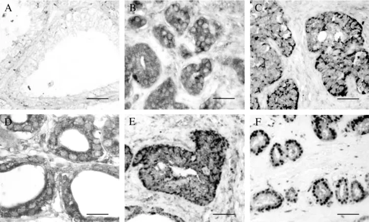 Fig. 4. α-PAK was negative in normal prostate (A) but positive in the cytoplasm of epithelial cells in PC (B) samples