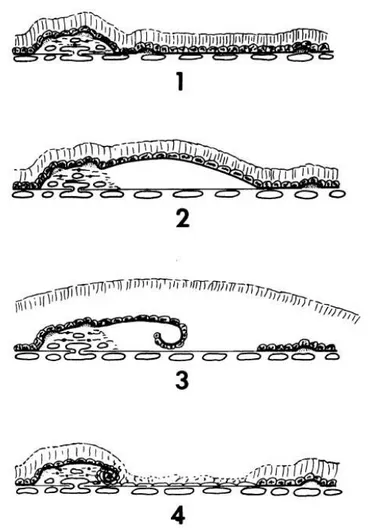 Figura  9.  Fases  de  desarrollo  del  desprendimiento  seroso  y  de  las  fisuras  del  epitelio  pigmentario