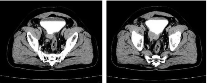 Figura  1-2-3-4  tomografía  axial  computarizada  con  contraste  en  pelvis  de  cortes  axiales,  donde se aprecia  las siguientes características  Imagen  axial  de  tomografía  computarizada  tras  administración  de  contraste  intravenoso