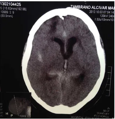 Fig. 2: Tomografía computarizada de cerebro sin contraste corte axial. 