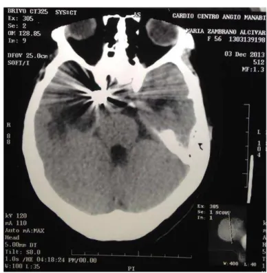 Fig. 8: Tomografía computarizada de cerebro, imágenes postoperatorias  de evolución y seguimiento corte axial