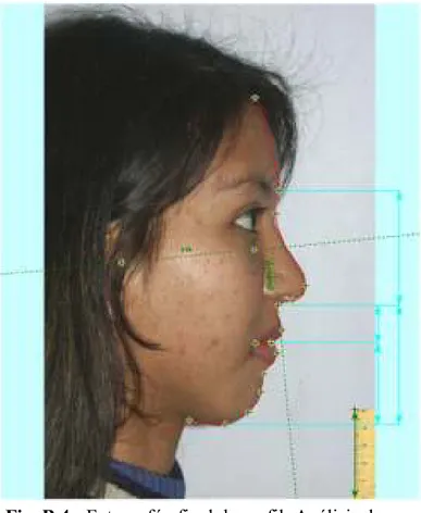 Fig. B 4.- Fotografía  final de perfil: Análisis de  Epker y Fish  