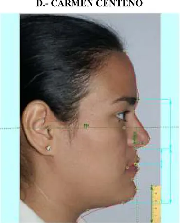 Fig. D 1.- Fotografía  inicial de perfil: Análisis de  Epker y Fish 