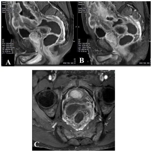 Fig. 1. Resonancia Magnética de pelvis con contraste de gadolinio en  secuencia Spir. Imágenes A y B en corte sagital, imagen C en corte axial