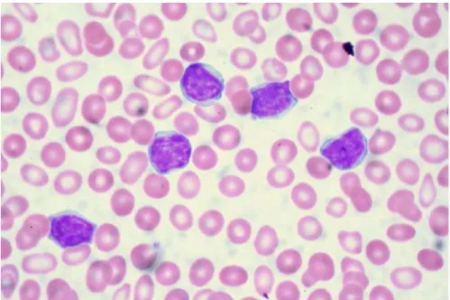 Figure 1: Microscopic image of blood smear containing lymphocytes (purple, with granulated nuclei) (Source: Euthman,  https://www.flickr.com/photos/euthman/2869815349  ) 