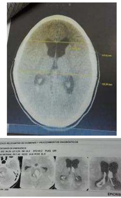 Figura 1. Se muestran lesiones hiperdensas que se extienden del tronco encefálico, con edema perilesional, presencia de sangrado que  invade el 3er y 4to ventrículo y los ventrículos laterales