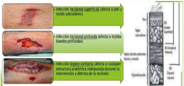 TABLA 1. Factores de riesgo para el desarrollo de infecciones de sitio quirúrgico Factores del paciente   Factores 