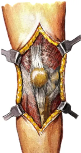 Figura 1. Sistema de estabilización de la rótula. 9 