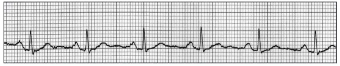 Figura 1.1. Papel milimetrado en que se ve el electrocardiograma. 