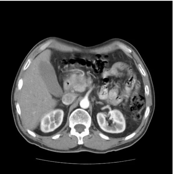 Figura 1. TAC abdominal donde se aprecia un carcinoma de páncreas. Ref. A. Utrillas et al