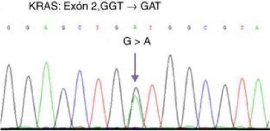 Figura 6. Mutación G12D, correspondiente con la localización 228 tomando como referencia  la secuencia RefSeq NM004985.4 