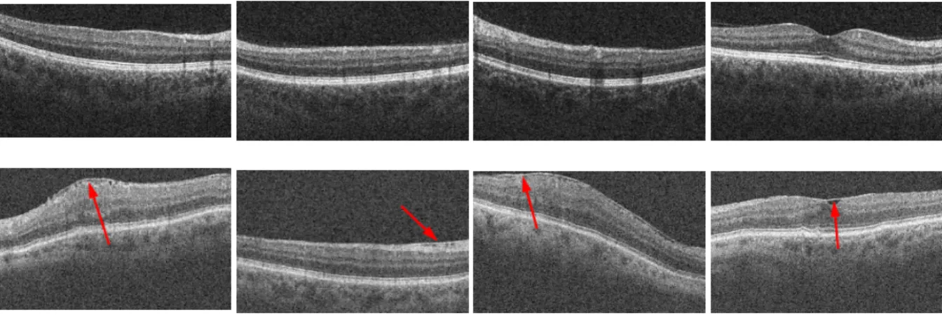 Figure 1. Multiple instances of 2D Optical Coherence Tomography (OCT) slices from different 3D OCT volumes with and without the presence of the Epiretinal Membrane (ERM)