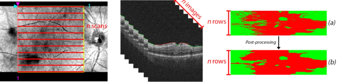 Figure 6. ERM classification process of a 3D OCT volume. A total of n OCT scans were generated for each patient, situated equidistantly in the complete retinal surface