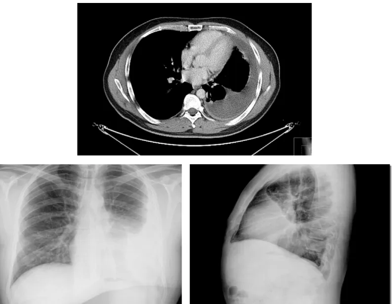 Ilustración 10. TC (ventana mediastínica) y Rx tórax de paciente diagnosticado de derrame pleural por asbesto 