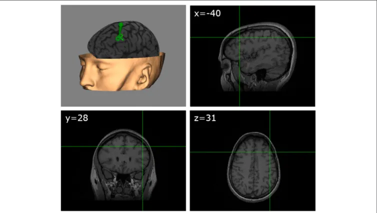 FIGURE 2 | TMS target. Schematic figure showing on an MRI 3D reconstruction from a representative participant (with permission) the TMS targeted left dlPFC region identified according to standardized MNI coordinates (x = −40, y = 28, z = 31).