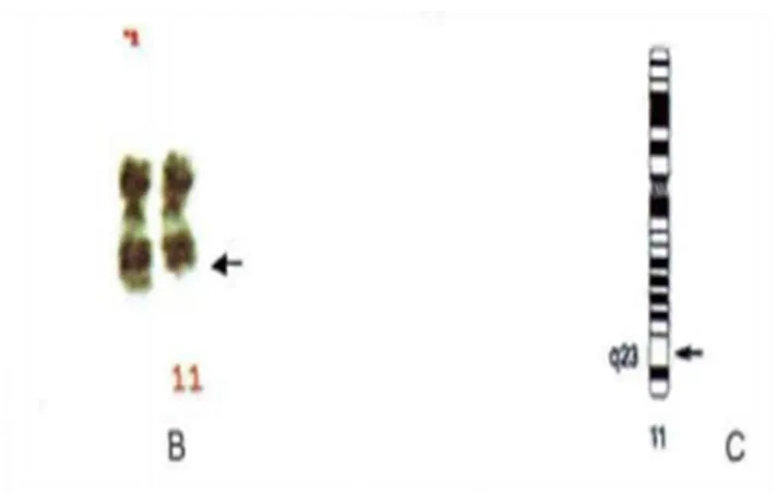 Ilustración  1-1:  Cromosomas  con  alteración  citogenética  con  deleción  distal  del brazo largo del cromosoma 11 